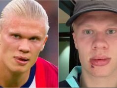 Erling Haaland mengalami cedera wajah yang parah di bus tim Norwegia