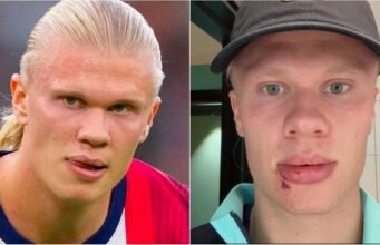 Erling Haaland mengalami cedera wajah yang parah di bus tim Norwegia
